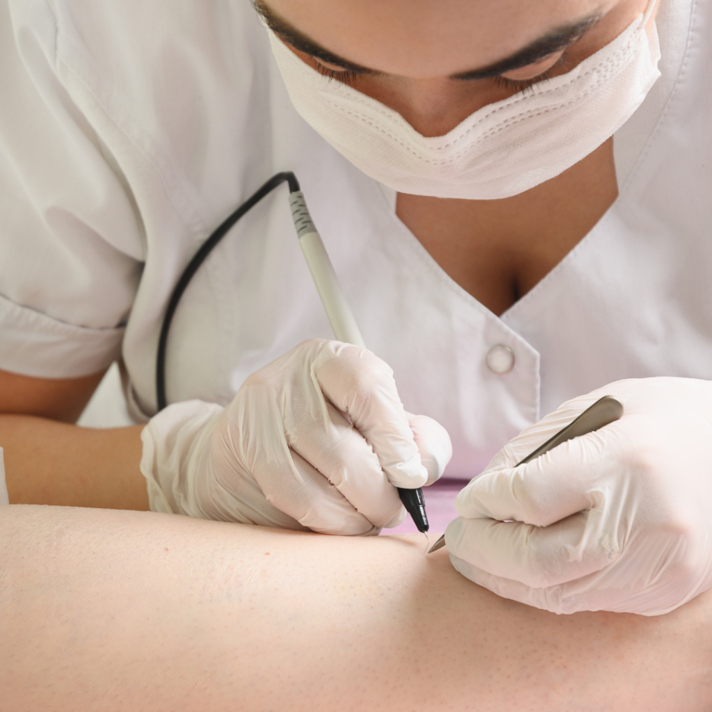 İğneli Epilasyon Ataşehir